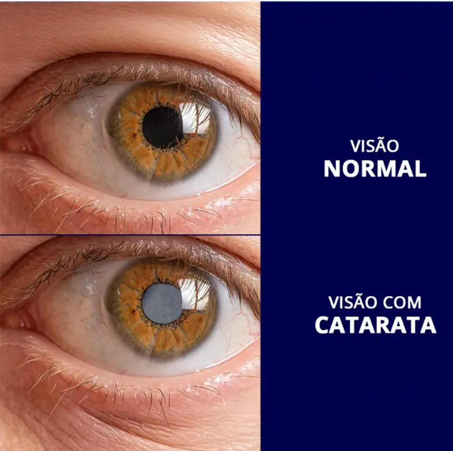 Cirurgia de Catarata